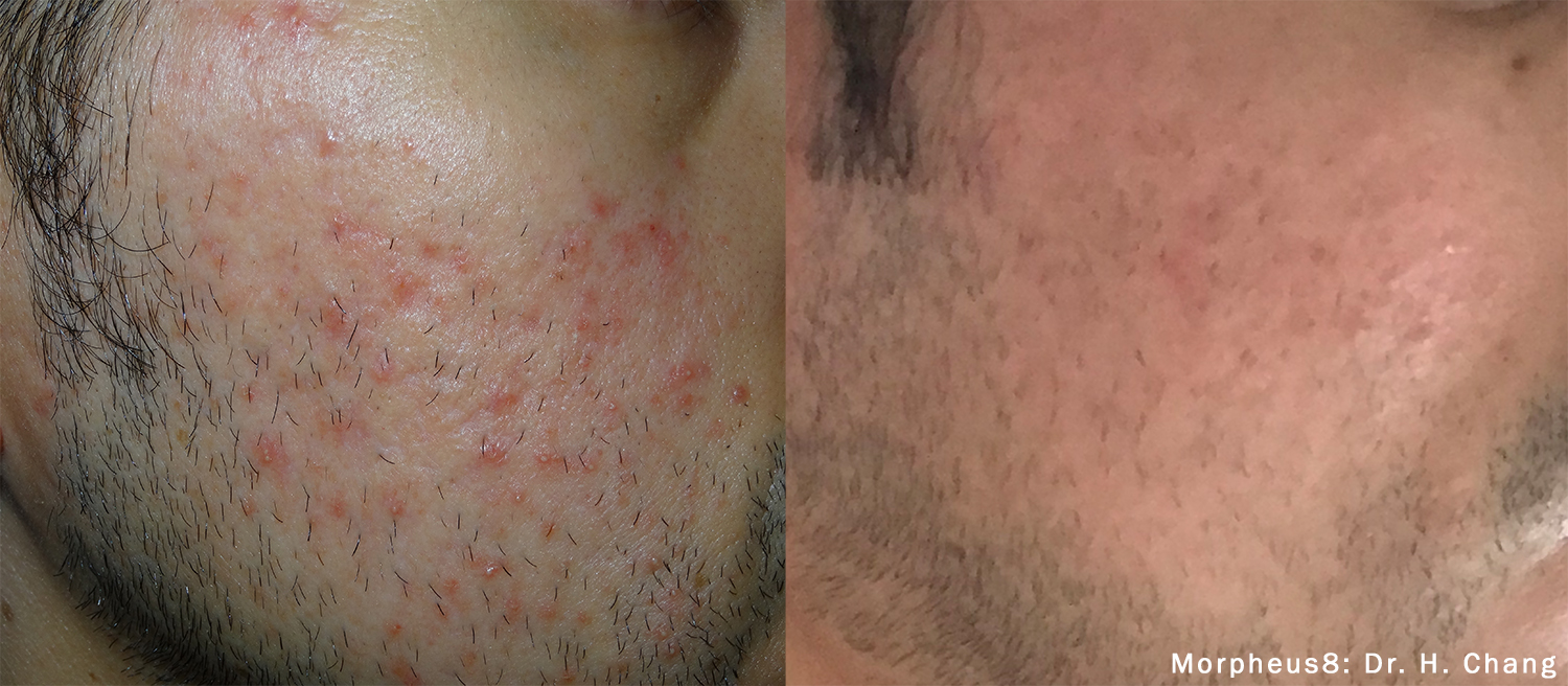 HC_Morpheus8_1_Acne1tx15kj