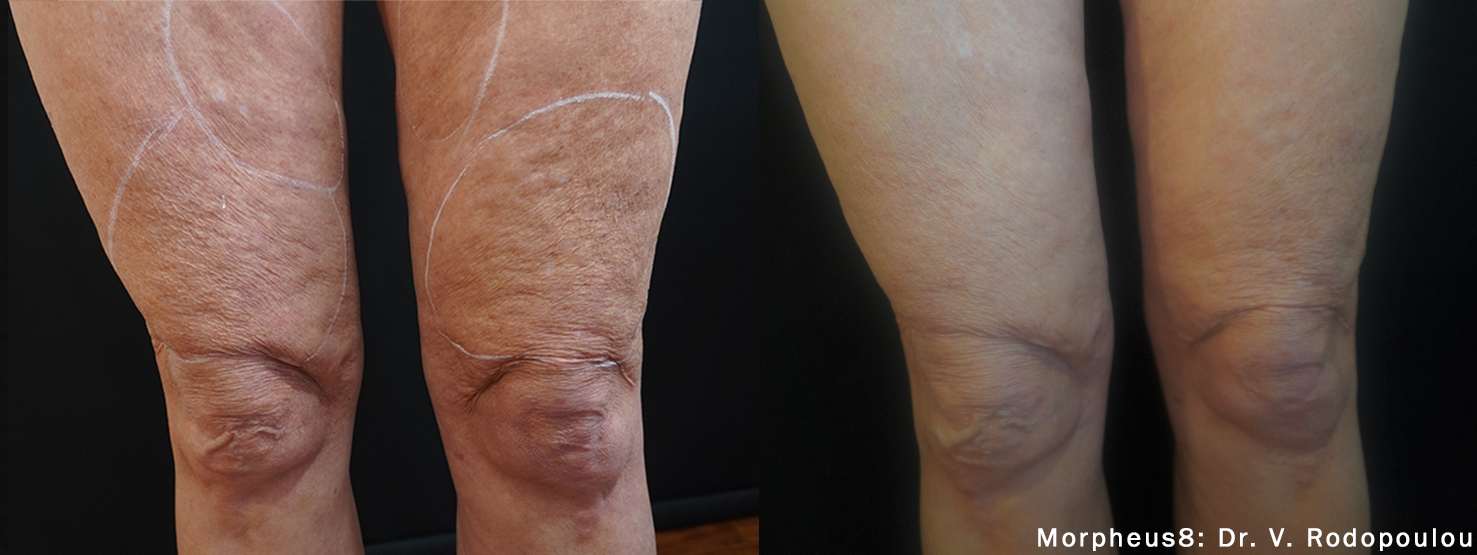 Morpheus8_Thighs_VRodopoulou