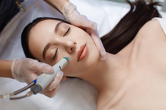 microneedling